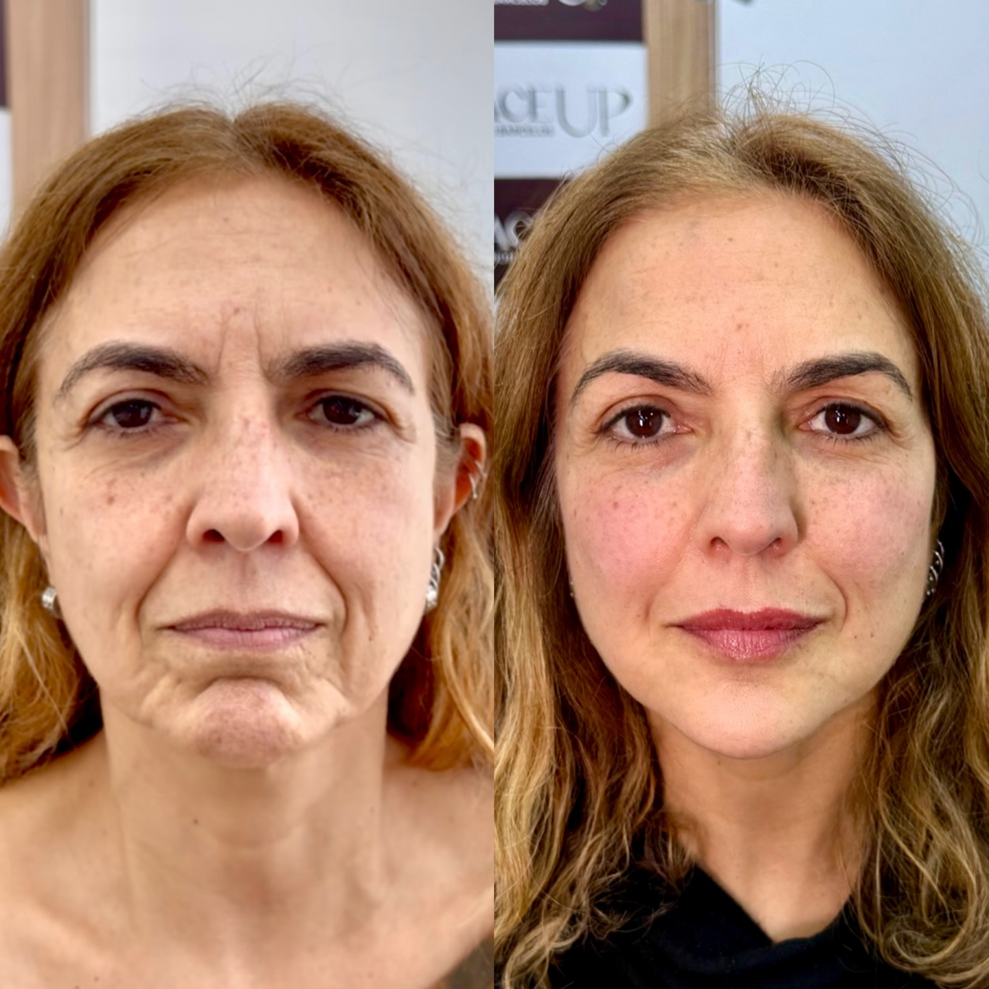 Tratamentos Faciais